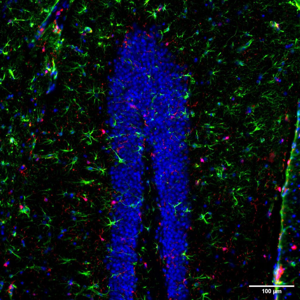 in vivo-Neurodégénérescence-Aβ-young mice-Fluorescence-astrocyte-microglia-neuroinflammation-dentate-gyrus