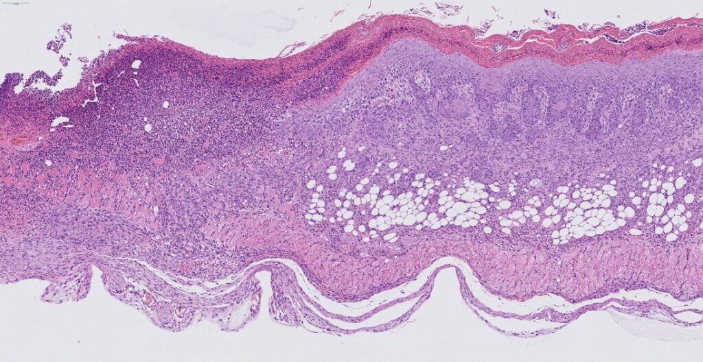 histology results on Skin with Atopic Dermatitis treated with placebo