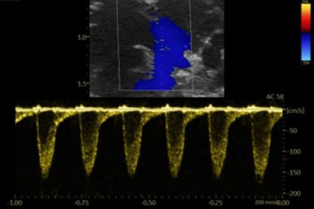 Syncrosome-cardio-PAH-right-heart imaging