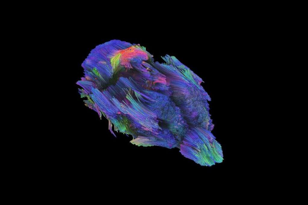 stroke-invivo-tracto imaging