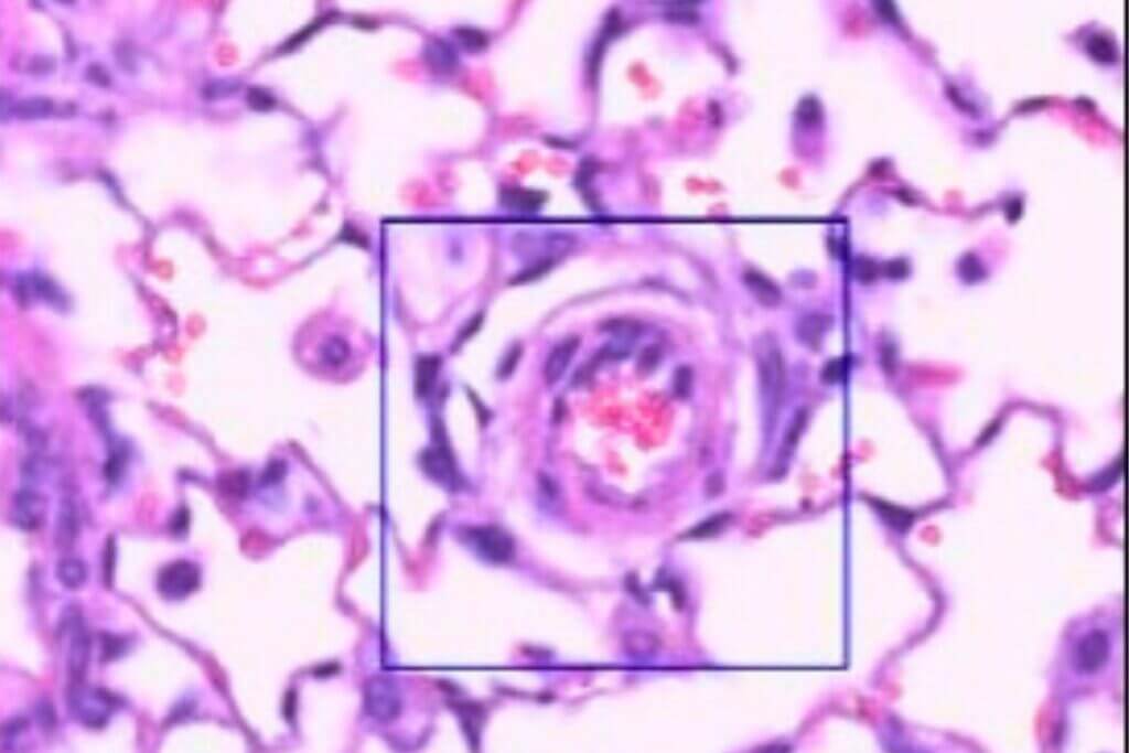 syn-pah-cardiopulmonary-right-heart