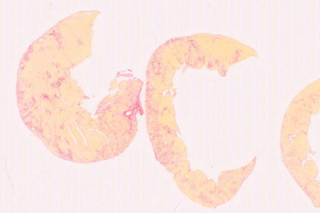 pah-cardiopulmonary-right-heart-fibrosis