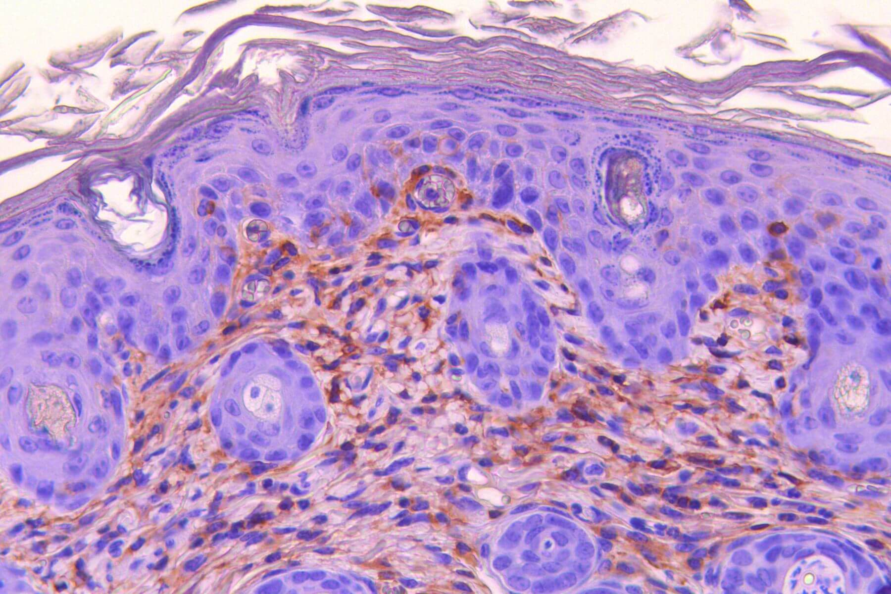 preclinical dermatology on psoriasis model of skin x40 with IHC