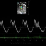 hfpef-cardiology-left-heart